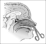 Fig. 14-7 Hypophysectomy- surgical removal of the pituitary gland.