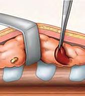 During Surgery You may need one or more parathyroid glands removed. The decision about how many glands to remove is often made during surgery.