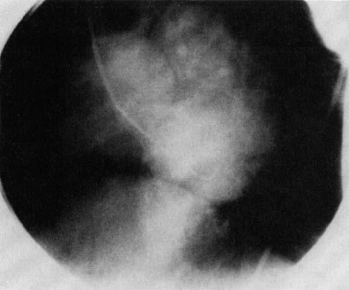 298 The Annals of Thoracic Surgery Vol 45 No 3 March 1988 A Fig 2. (Patient 6.) Cineangiogram and line interpretation showing the aneu ysm (A) of the aortic root and the mitral valve insufficiency.