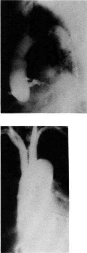 302 The Annals of Thoracic Surgery Vol45 No 3 March 1988 Fig 5. (Patient 6.) Aortograms and line interpretations showing the composite valve graft in place and functioning.