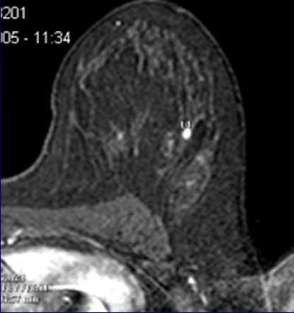 Interpretation of breast MRI Homogeneous enhancing oval mass with smooth borders.