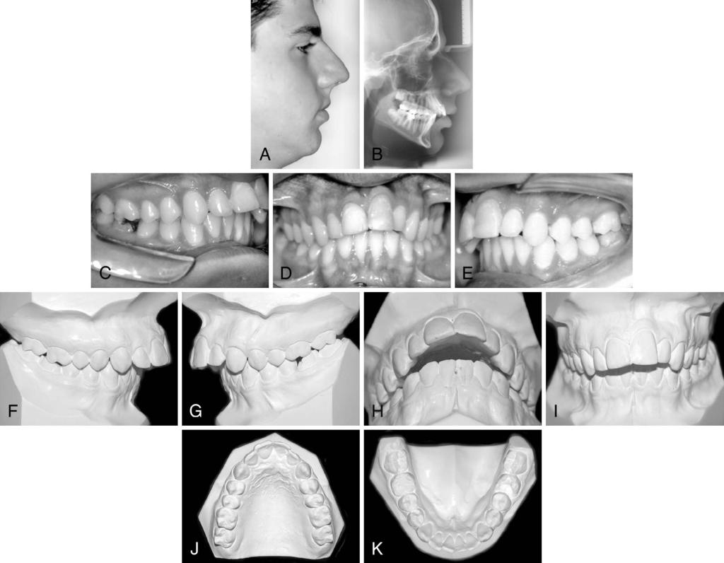 DENTAL ARCH DIMENSIONS IN CLASS II 467 Figure 1. Orthodontic dignosis is bsed on fcil (1A), rdiogrphic (1B), nd occlusl (1C to 1K) nlyses.