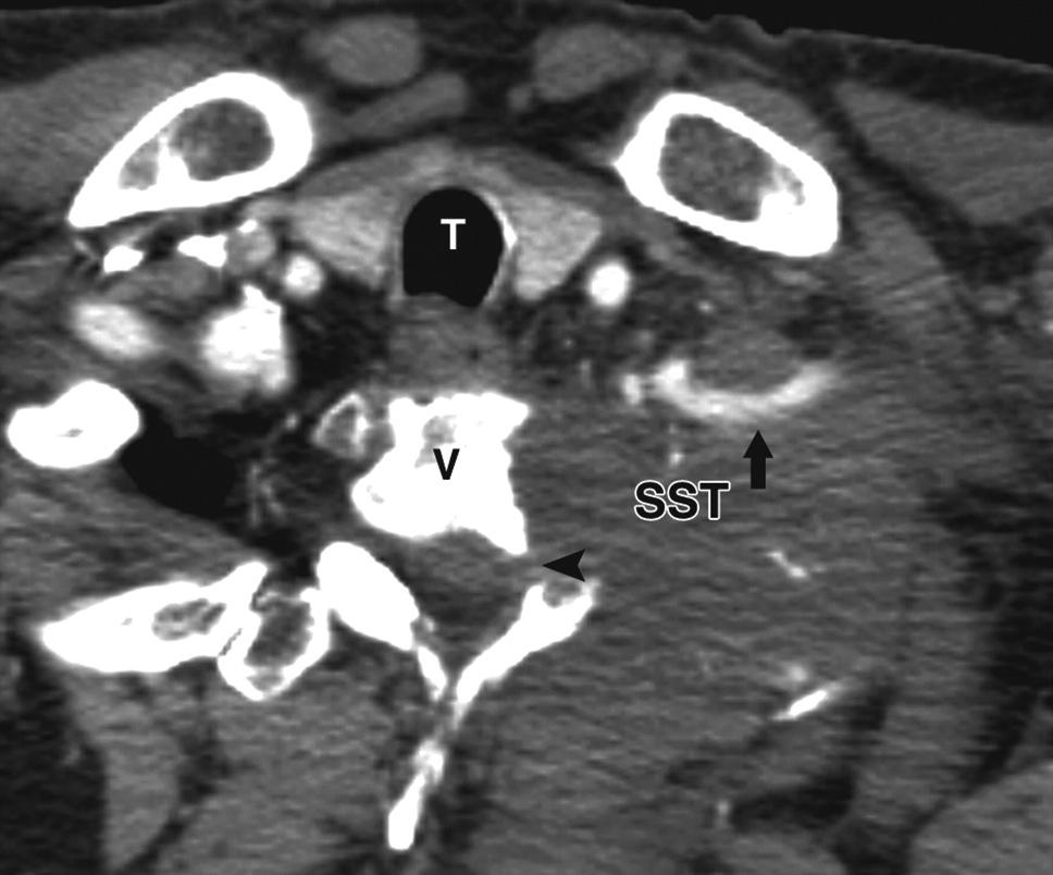 Superior sulcus tumor in a 56-year-old man with sensory loss in