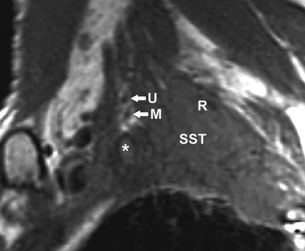 SST invading the fat above the apical pleura and encasing the subclavian artery (*).