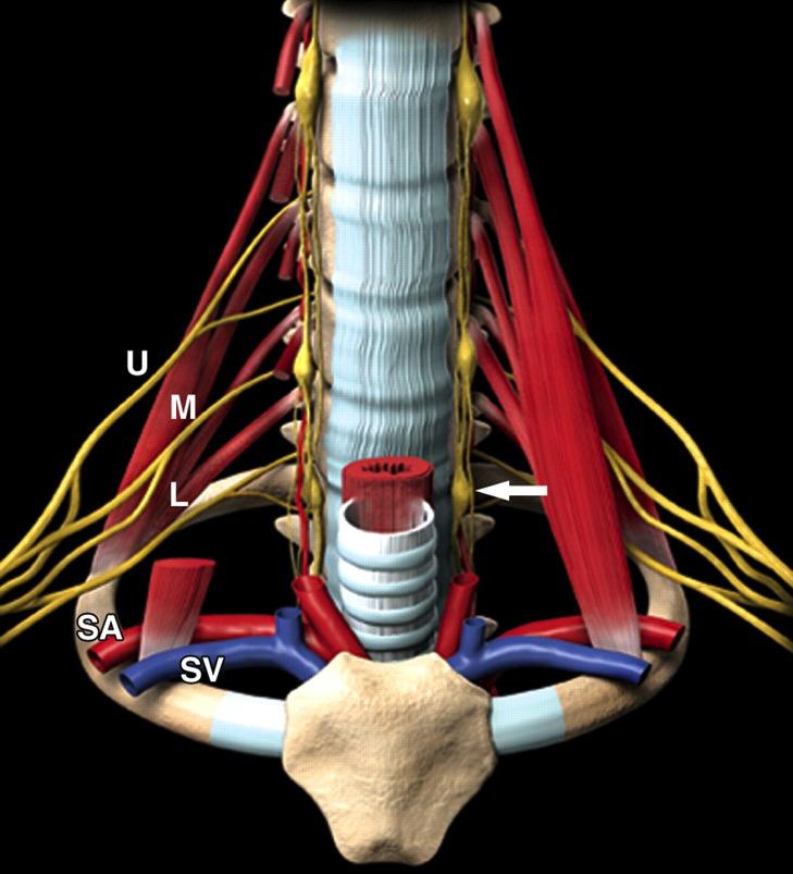 Three-dimensional drawing shows the surgical anatomy of the superior sulcus Anatomy of the superior sulcus divided into anterior, middle, and posterior compartments by the scalene muscles.