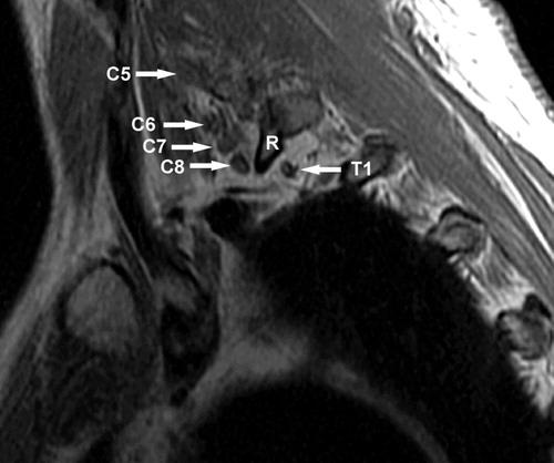Sagittal T1-weighted MR image of the superior sulcus shows the courses of the C5 through T1 nerve roots laterally