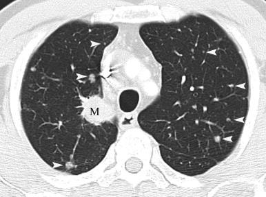 Patient with NSCLC with hematogenously disseminated lung