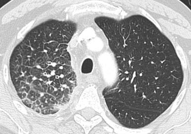Patient with NSCLC and lymphangitic carcinomatosis.