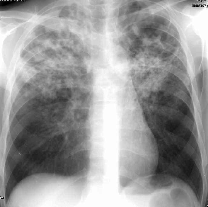 Role of Radiology Chest radiography is a highly sensitive technique for diagnosing pulmonary TB (imuno and immunocompetent patients) but it is unspecific (no pathognomonic signs).