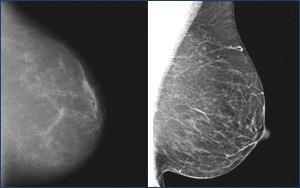 Role of Radiology Early detection, accurate diagnosis and appropriate treatment are the primary methods of breast