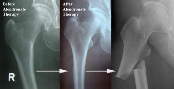 Atypical femoral fracture related to
