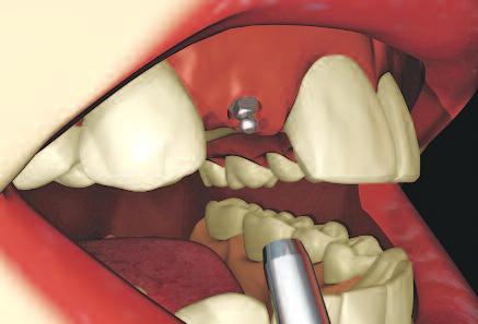 MILO Abutment Preparation and Impression Prosthetic Techniques The MILO is an extremely