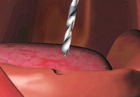 When thin, porous or irregularly contoured bone is encountered, or when gingival manipulation or