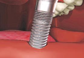 Implant seating is accomplished when either the Ratchet Driver (MDLRD) or the