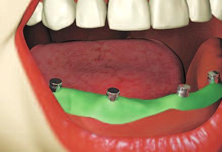 place the rubber dam over each abutment, leaving