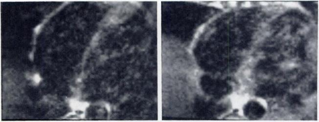 AJR:142, April 1984 MRI OF HEART AND MAJOR VESSELS 663 Fig. 2.-Comparison of nongated (upper) and electrocardiogram-gated (lower) images at two transverse levels through caudal aspect of ventricles.