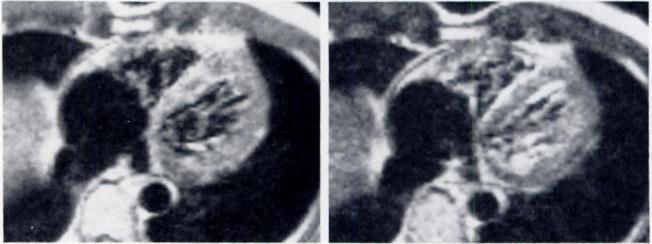First SE images (TE = 28 msec, left) as compared with second SE images (TE = 56 msec, right) contain less signal within chamber and better delineation of endocardial interface.
