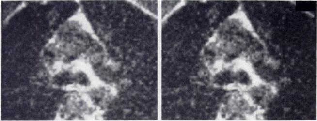664 HIGGINS ET AL. AJR:142, April 1984 Fig. 4.-Optimizing imaging technique for blood vessels. Nongated (upper) and gated (lower) images of upper mediastinum.