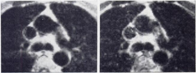 Signal-to-noise ratio for vascular structures is greatest for gated first SE image (lower left).