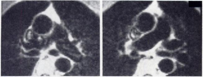 Images of the Great Vessels As was observed for the heart, there is also clearer discrimination of mediastinal vessels in gated MR images (fig. 4). In Fig. 5.