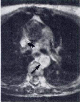 AJR:142, April 1984 MRI OF HEART AND MAJOR VESSELS 665 Fig. 6.-Mediastinal vessels. Gated images at Fig. 7.-Coronary arteries. Axial images.