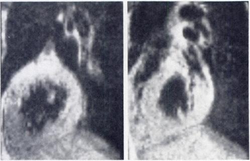Images corresponding to systole generally have no intraluminal signal (figs. 4 and 5), whereas images acquired in diastole show intense intraluminal signal (fig. 6).