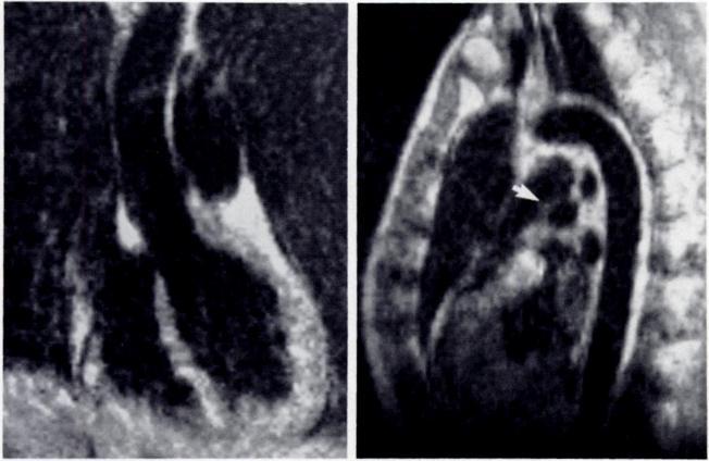 Sagittal images also depict the entire length of the thoracic aorta; the smooth anterior and posterior walls of the normal aorta are clearly demonstrated (fig. 10).