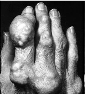 Severe Tophaceous Gout: What if.. You could convert relatively insoluble uric acid to a more soluble and excretable metabolite? You could achieve a sustained reduction in uric acid levels below 5?