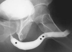 Cysto/Urethroscopy Retograde