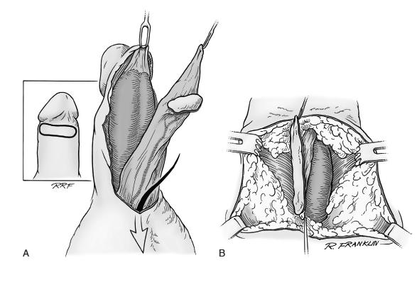 This usually takes place within 7 d when most patients are stable and most pelvic bleeding has resolved.