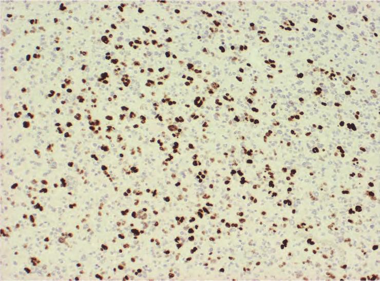 460 Management of CNS Tumors d The region showed increased atypical oligodendroglial cells of various sizes and forms (A: HE stain, 100).