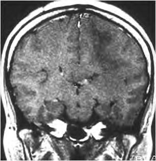 T1-weighted MRI with Gd-DTPA (C, D) demonstrated