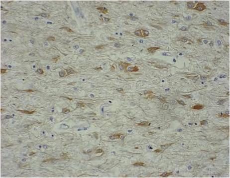 Clinicopathological Diagnosis of Gliomatosis Cerebri 455 e f Klüver-Barrera stain (A) demonstrated the affected region to be a broad region of myelin destruction extending from the white matter of
