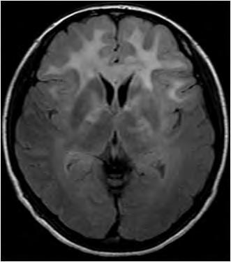 456 Management of CNS Tumors (a) (b) (c) (d) FLAIR MRI (A, B) demonstrated diffuse high intensity in the white matter of both frontal lobe and