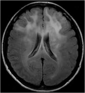 T1-weighted with Gd-DTPA (C, D) demonstrated low intensity in the white matter of the left frontal lobe without enhancement. Fig. 3.