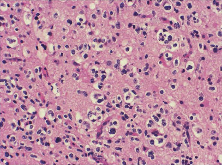 Clinicopathological Diagnosis of Gliomatosis Cerebri 457 fluorescence in situ hybridization (FISH), she was found to be positive for 1pLOH (1p36) and 19qLOH (19q36) (Fig. 4 C, D).
