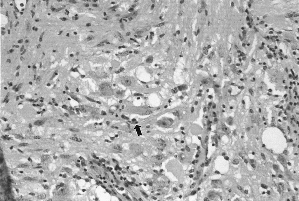 a glial component. Finally, gangliocytoma was diagnosed. Case 2 A previously healthy 59-year-old woman presented with stubborn headache and dizziness which had begun six months earlier.