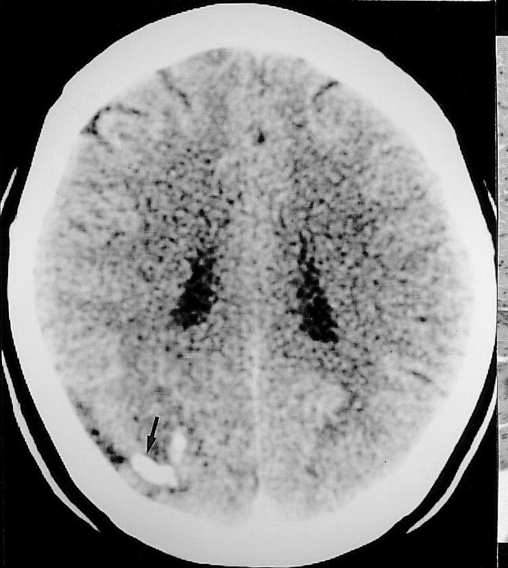 Note the presence of subdural hygroma adjacent to the tumor (open arrows). B.