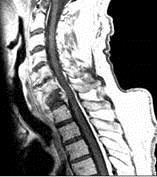 Fracture Spinal