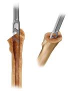 Enter the femoral canal using the box osteotome at the junction of the femoral neck and the greater trochanter.