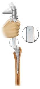 FEMORAL BROACHING Figure 7 BROACH IMPACTION Tapered reamers are available for