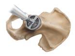 ACETABULAR PREPARATION ACETABULAR PREPARATION Ream the acetabulum until healthy subchondral bone is reached and a hemispherical dome is achieved (Figure 2).