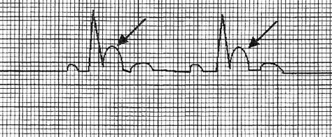 Figure. An electrocardiogram demonstrating Osborn waves, representing a positive deflection at the ST segment. (Reprinted from Thornton D, Farmer JC. Hypothermia and hyperthermia.