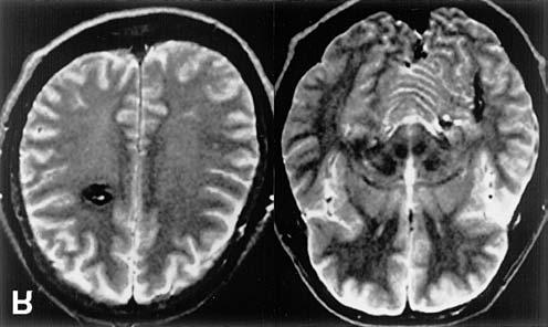 392 N. Takenaka et al. Fig. 1 Axial T 2 -weighted magnetic resonance images obtained 9 months before gamma knife radiosurgery showing mixed intensity lesions suggesting cavernous malformations. Fig. 2 Axial T 2 -weighted magnetic resonance images showing the dose planning for lesions of the right frontal lobe (A) and the left temporal lobe (B).