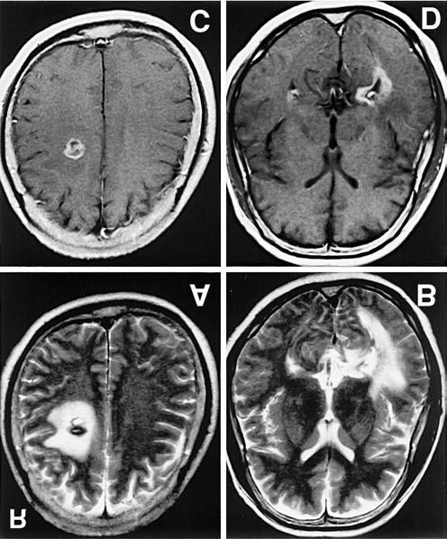 mixed intensity signals surrounded by low intensity rims in the right frontal and left deep temporal regions, suggesting multiple intracranial cavernous malformations 8) (Fig. 1).