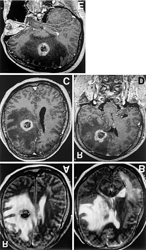 Extensive Brain Edema After GKRS 393 Fig.