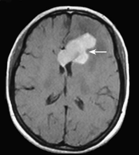 Eighteen lesions were located deep within the brain, whereas the other three were located superficially. The mean size of the lesions was 39 ± 1.71 cm (range 2.0-7.0 cm).