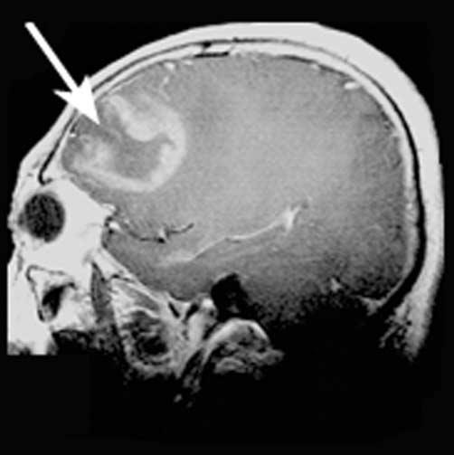Of the 21 patients with monofocal lesions, ten received a plain CT scan. Furthermore, of these ten patients three had an available enhanced CT scan.