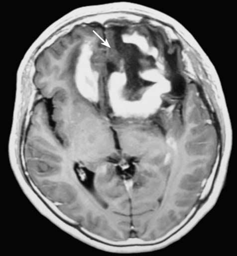 Two cases involved both sides of the tentorium, one case with two lesions involved the cerebellar hemispheres bilaterally, whereas the other two cases had only supratentorial lesions.