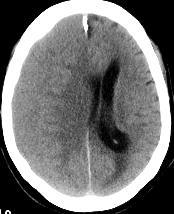 15 Brain edema and infarction around 20 Normal Brain tissue From 30 To 40 Recent hematoma From 60 To 90 Calcifications More than 100 Bone From 200 and above The